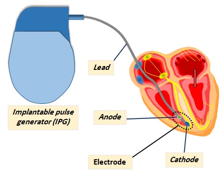 Implantable Pacemaker Systems Contain the Following Components